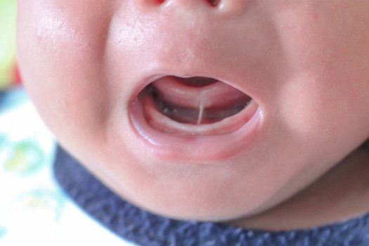 Closeup of infant’s tongue tie