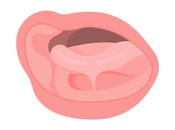 Animated smile in need of myofunctional treatment