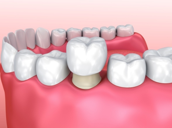 Animated smile during dental crown placement