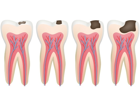 Animated tooth showing progress of damage before pulpotomy is necessary