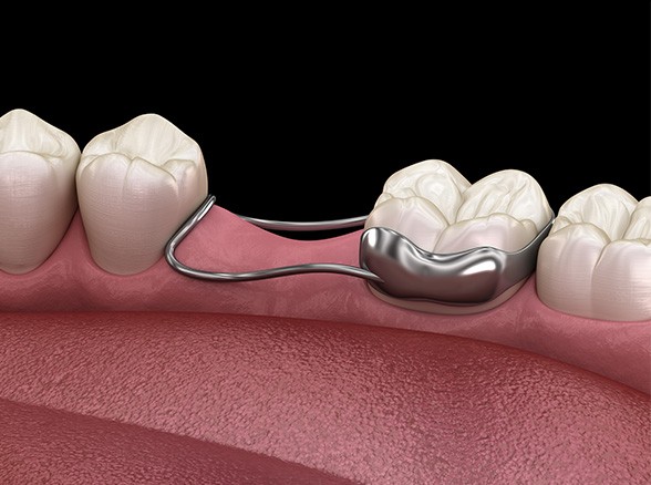 Animated smile with a space maintainer appliance in place