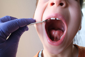 Boy opening mouth and showing a tongue tie